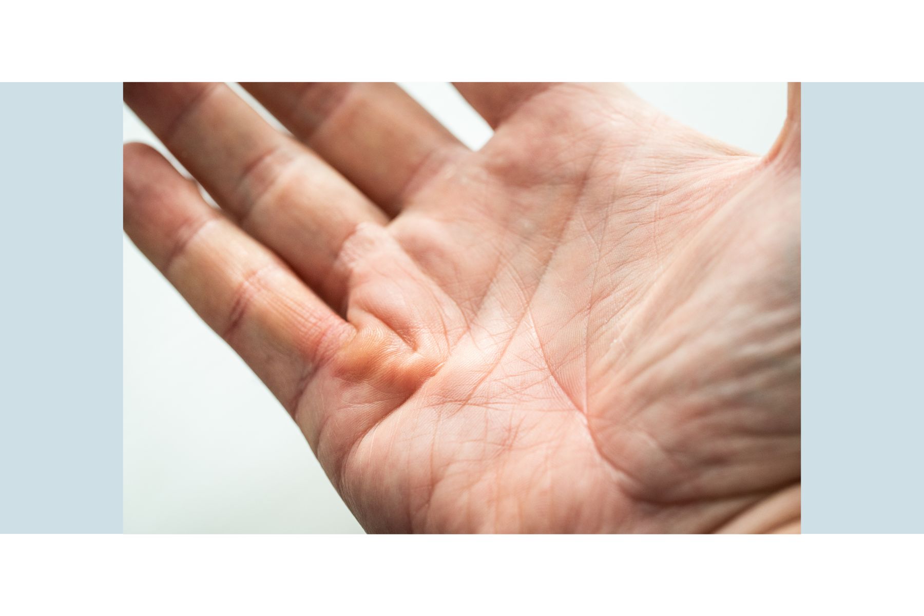 Enfermedad de Dupuytren - contractura de los dedos de la mano