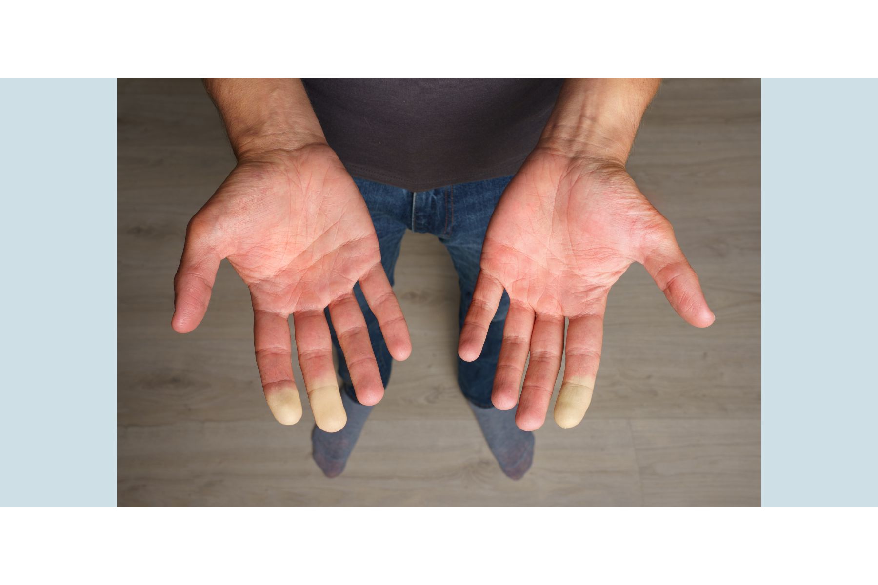 Fenómeno de Raynaud - Trastorno vascular vasoespástico